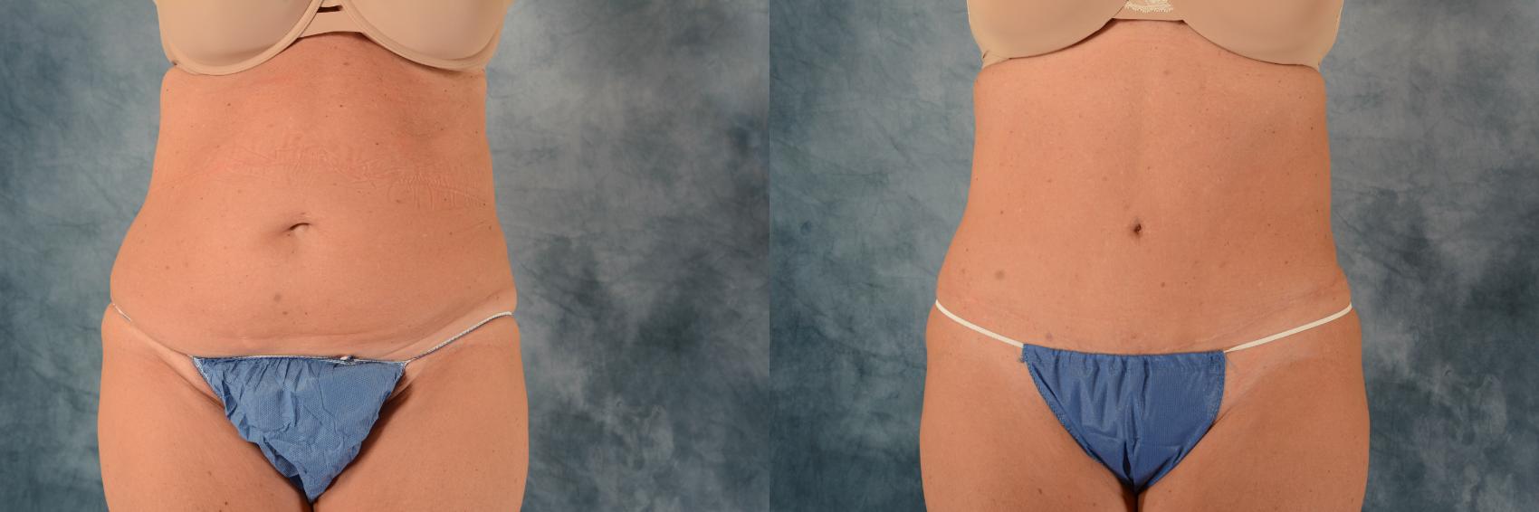 Before & After Tummy Tuck (Abdominoplasty) Case 729 Front View in Tallahassee, FL