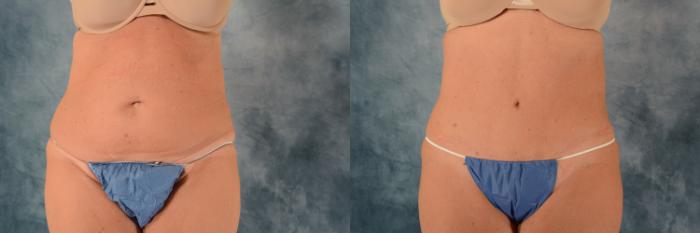 Before & After Tummy Tuck (Abdominoplasty) Case 729 Front View in Tallahassee, FL