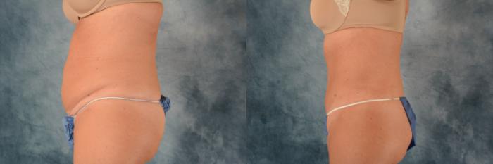 Before & After Tummy Tuck (Abdominoplasty) Case 729 Left Side View in Tallahassee, FL